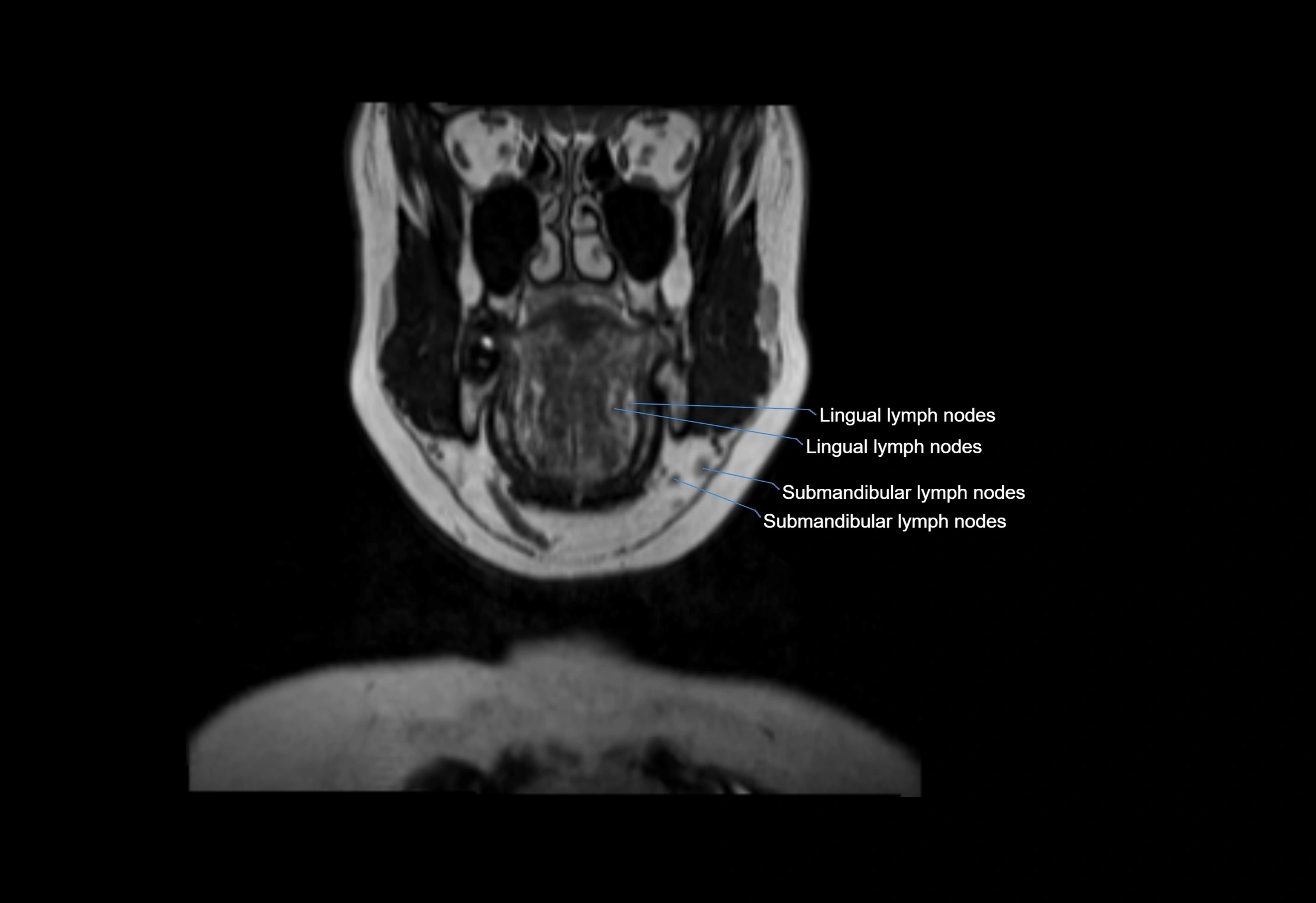 Neck coronal lymph node cross sectional MRI anatomy 3T MRI  image-img-00001-00056.webp
